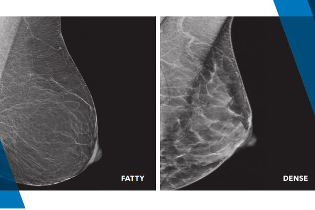 Dense Breasts  Shaw Cancer Center in Edwards, CO